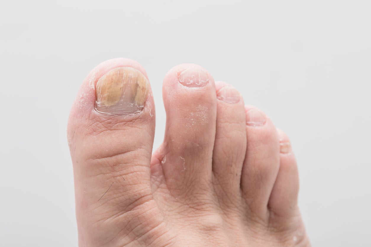 Managing Foot And Toenail Fungus: Here Are Some Tips You Should Try |  OnlyMyHealth